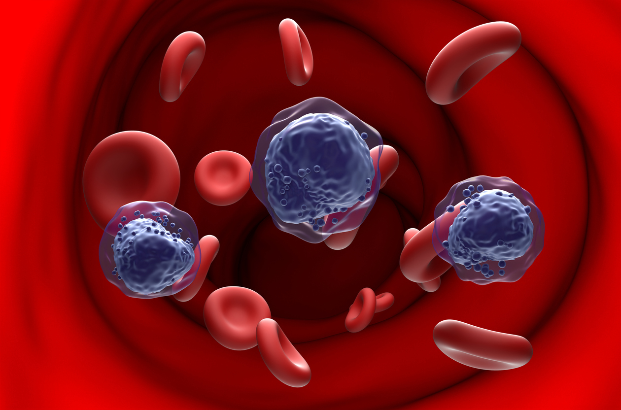 Acute myeloid leukemia